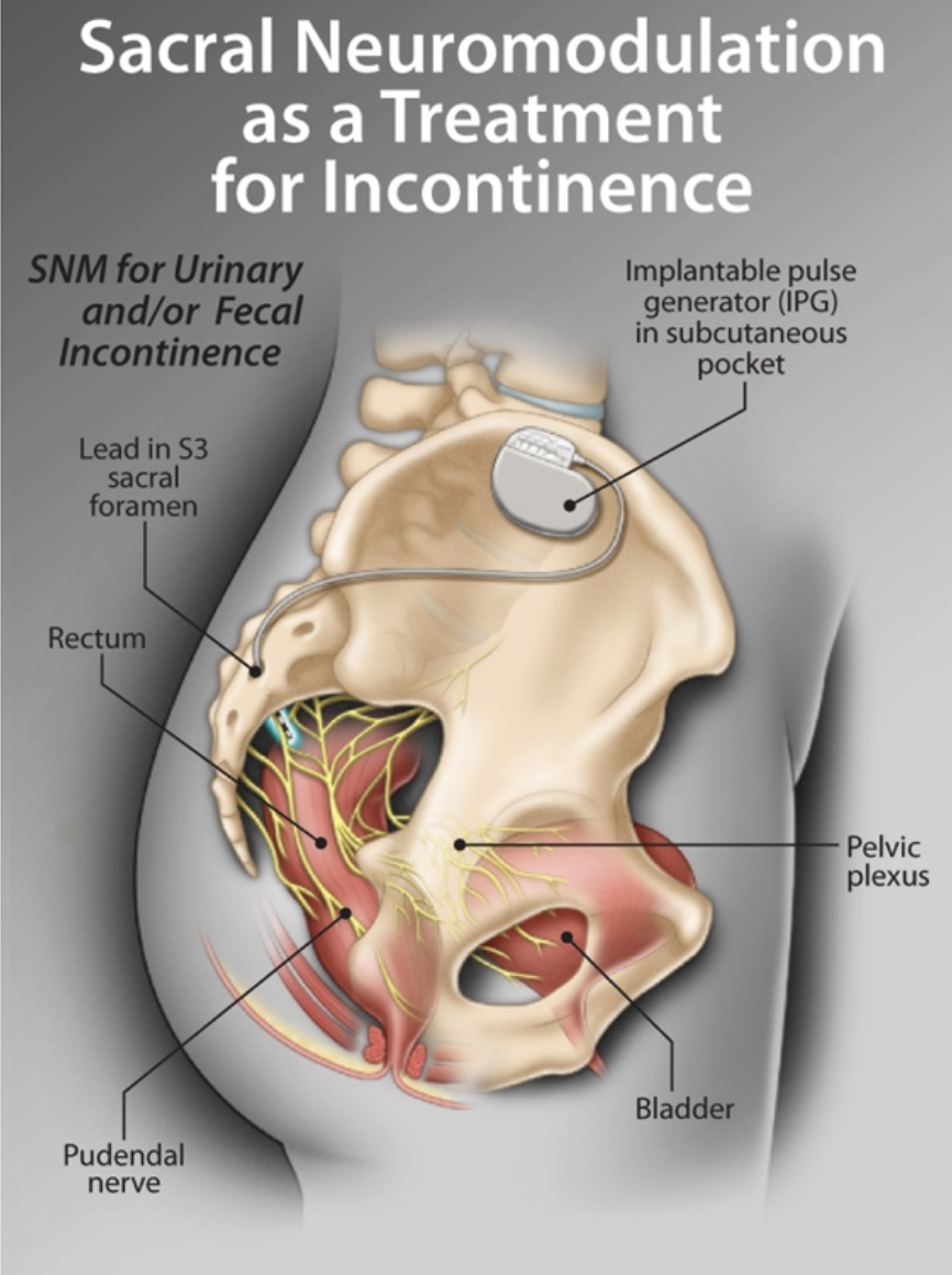 Figure 1: Implanted sacral nerve stimulator