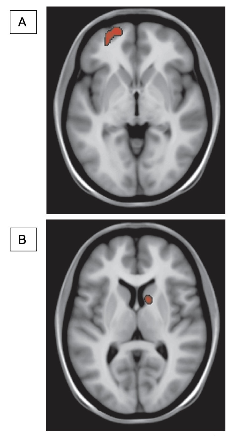 Figure 2: Changes in regional cerebral blood flow